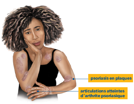 Illustrations d’une main, d’une cheville et d’un pied montrant des zones pouvant être atteintes d’arthrite psoriasique.